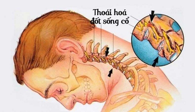Thoái hóa đốt sống cổ ở dân văn phòng: Nguyên nhân & hướng cải thiện tự nhiên 25 Thoái hóa đốt sống cổ